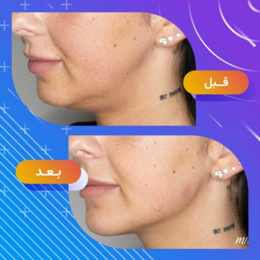 قبل و بعد جراحی