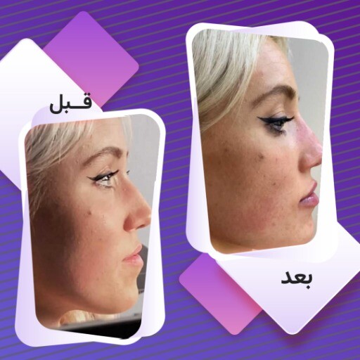 قبل و بعد زیبایی