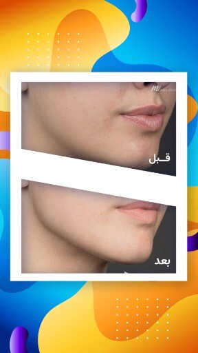 قبل و بعد رنگی