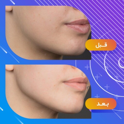 قبل و بعد جراحی