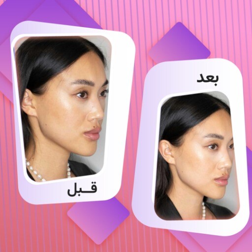 قبل و بعد زیبایی