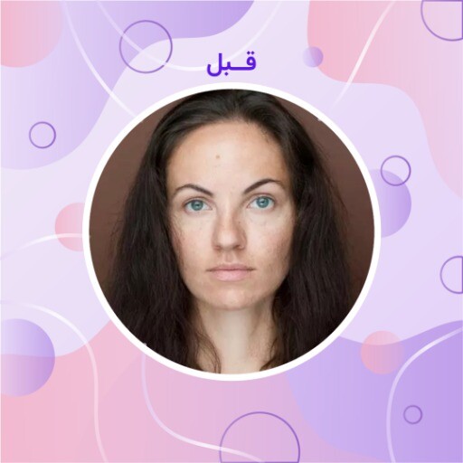 قبل و بعد ملیح